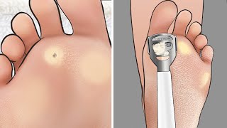 [ASMR] 대리만족 ! 발 각질, 티눈 케어 애니메이션 / Feet exfoliation, corn removal animation