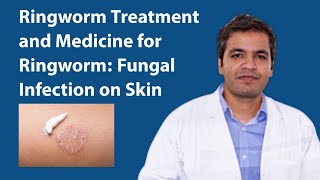 Ringworm Treatment: Fungal Infection on Skin Symptoms, Reason and Medicine for Ringworm Infection