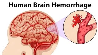 Brain Haemorrhage🧠How Brain Haemorrhage Occurs? 3D Animation video 
