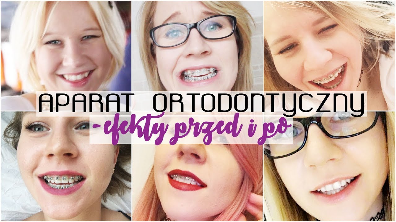 MOJA HISTORIA: Aparat ortodontyczny przed i po - metamorfoza, zdjęcia