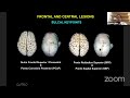 Frontal lobe anatomy and approaches to the ventricles