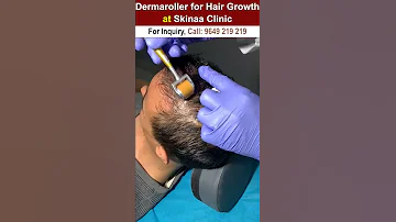 Dermaroller For Hair Growth Dermaroller Dermarollerforhairgrowth Hairgrowth Dermarollerforhair 