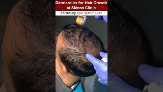 Dermaroller for hair growth dermaroller dermarollerforhairgrowth hairgrowth dermarollerforhair