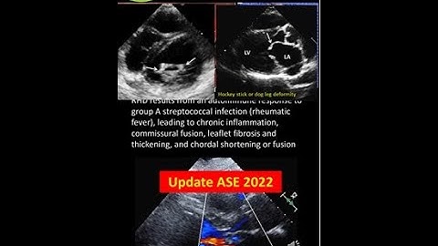 Mitral Stenosis (MS): Grading & Challenges; Update ASE 2022