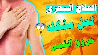 افضل علاج لحروق الشمس واحمرار الجلد | باسرع طريقه وعن تجربه