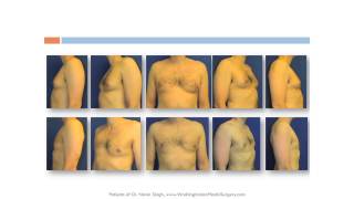 Gynecomastia, Chest Liposuction, Male Breast Reduction