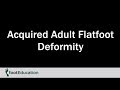 Acquired Adult Flatfoot Deformity