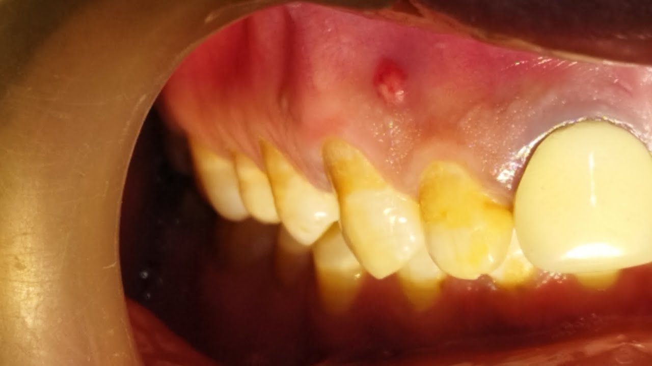 Root canal fail-Symptoms &Treatment|daant mein pus ka karan aur uska ...