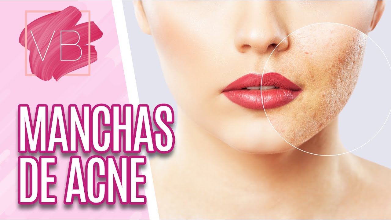 Como tratar manchas de acne - Você Bonita (15/09/20)