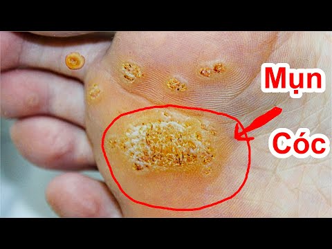 Cách Triệt Mụn Cóc Tận Rễ Ở Chân / Mẹo Tẩy Mụn Chai Triệt Để Lỗ Chân Lông . Đơn Giản Hiệu Quả