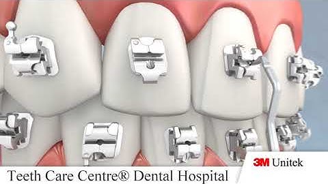 Mắc cài Why 3M Orthodontic Self Ligating Braces Treatment