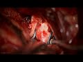 Anterior Clinoidectomy for Clipping of an ICA Cave Aneurysm and Resection of a Pituitary Adenoma