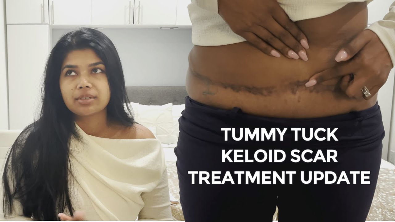 Tummy tuck keloid scar update, after one year of steroid