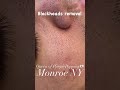 【毛穴エクストラクション】メンズ頬の産毛と角栓除去 #shorts
