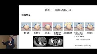 【第41回 希少がん Meet the Expert：GIST（消化管間質腫瘍）】講演：西田 俊朗【国立がん研究センター希少がんセンター】