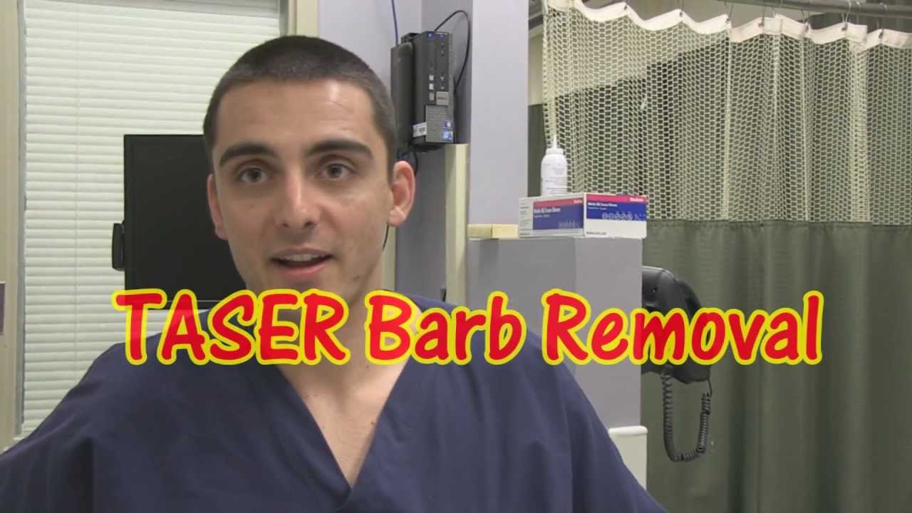 How To Remove Taser Barbs