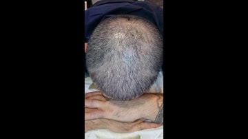SMP best in London Scalp Micropigmentation building density by El Truchan @ Perfect Definition