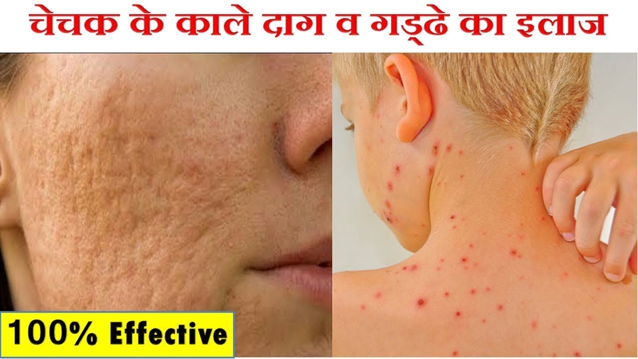 चेचक के दाग व धब्बे हटाने के घरेलु उपाय Chicken Pox Ke Nishan Kaise