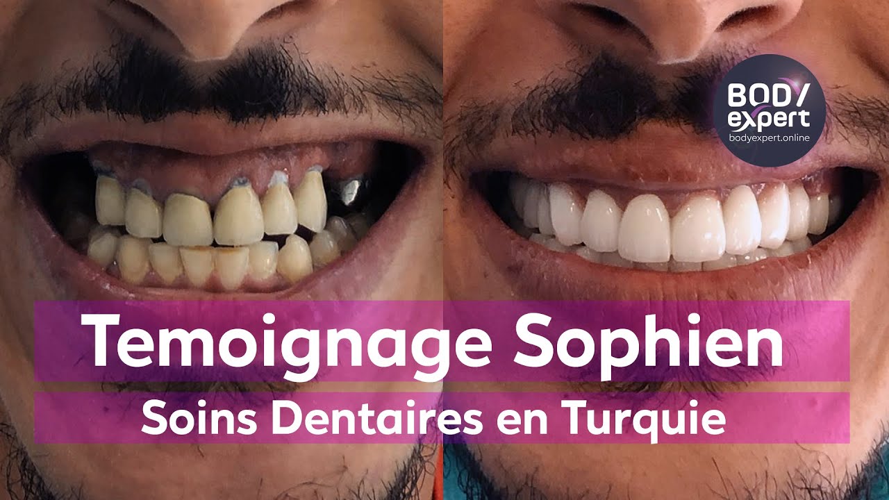 Implants dentaires mâchoire complète - Turquie, Dentiste