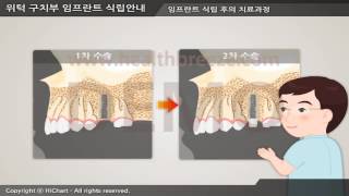 [시연용] c0149abko 위턱 구치부 임프란트 식립안내 2단계수술