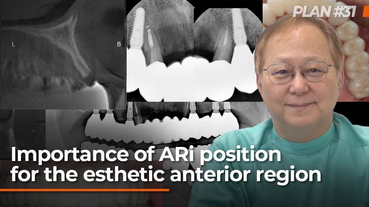 [Preview] Importance of ARi position for the esthetic anterior region ...