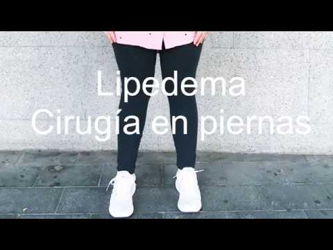 comida sana para adelgazar Lipedema: primera cirugía de piernas