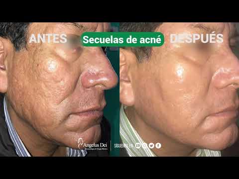 Antes y Después - Secuelas de Acné