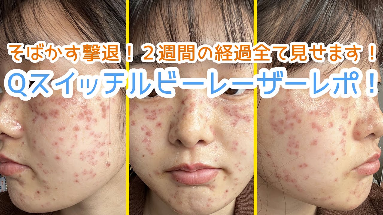 Qスイッチルビーレーザーでそばかすを撃退したよ！