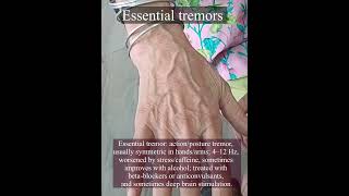 Essential tremors