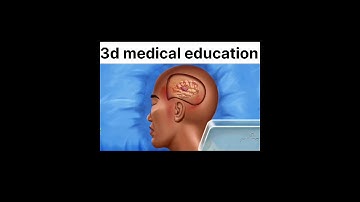 #3d #open #brain #tumore surgery in #best #animation video