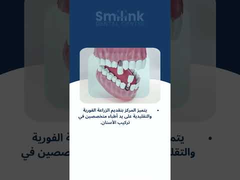 أنواع زراعة الأسنان واسعارها
