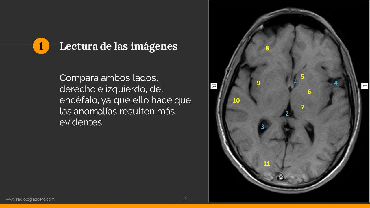 Analisis de las imagenes en la RM Cerebro