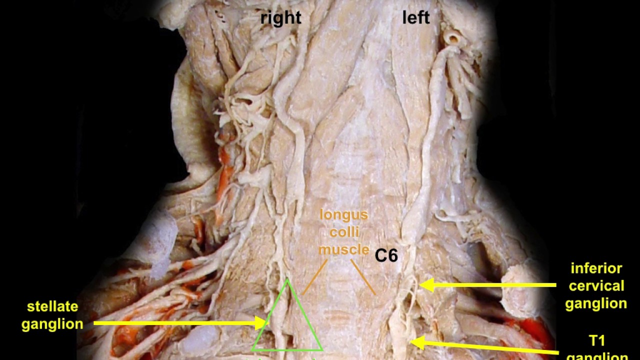 Cervical Sympathetic Trunk Block - YouTube