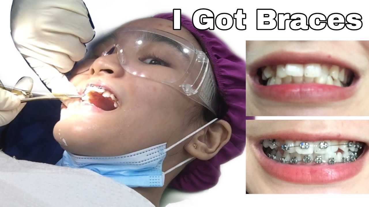 VLOG I Got Braces (Philippines) Krisha Carreon YouTube