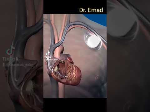 زراعة بطاريه القلب طبيب سوريا طبيبك في بيتك الدكتور مشاهدات اليوتيوب الجلطة  