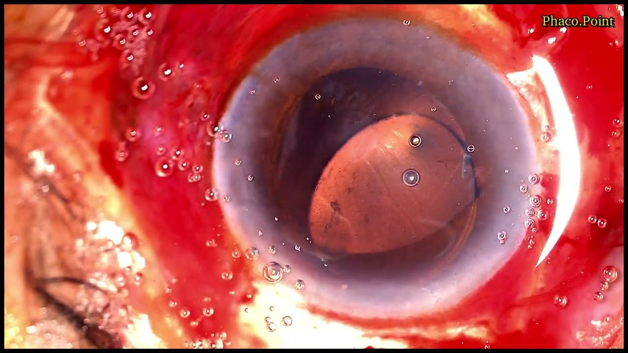 Intra operative Zonular Dialysis during Manual SICS.. How to Proceed ?