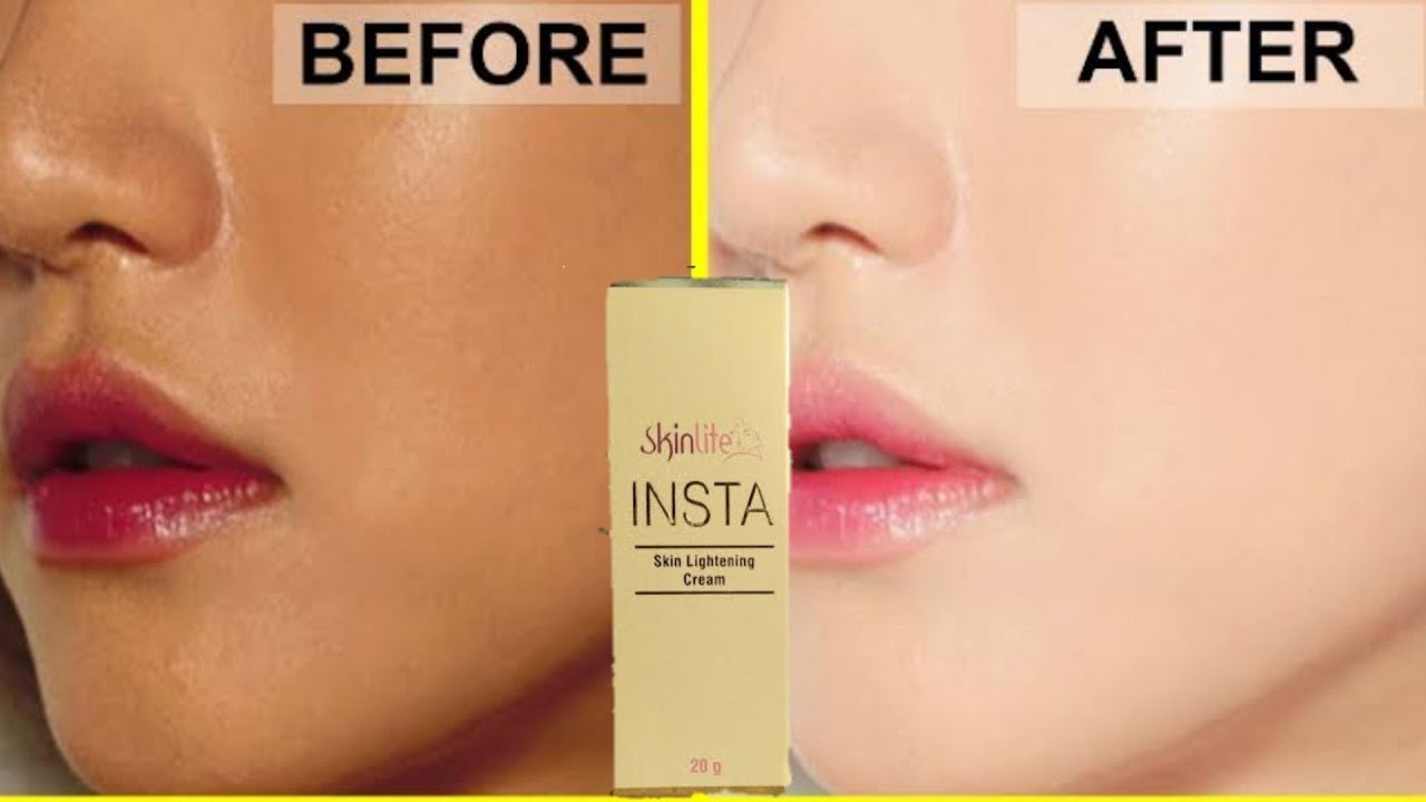 गोरा होने का सवसे वेहतरीन Cream |   Skinlite insta skin lightening cream review | 