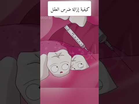 كيفية إزالة ضرس العقل