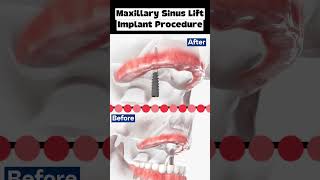 Can a sinus lift procedure be done simultaneously with dental implant placement?