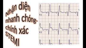 Đọc Điện tâm đồ(ECG): video 7: Nhồi máu cơ tim cấp có ST chênh lên( STEMI)