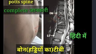 बोन(हड्डी )टीबी के बारे में सबकुछ | Bone TB in hindi| Potts spine | spinal TB| Bone Tuberculosis | screenshot 4