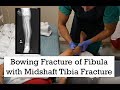 Bowing Fracture of Fibula and Midshaft Tibia Fracture