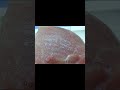 Electrosurgical Unit Cutting Effect #electrosurgery #surgery