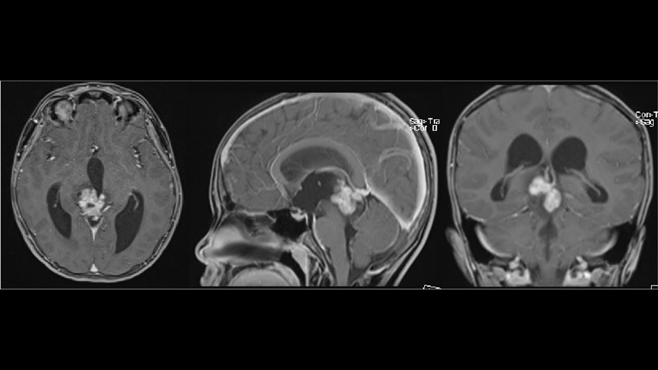 U mầm bào vùng tuyến tùng- Transchoroidal approach for pineal germinoma ...