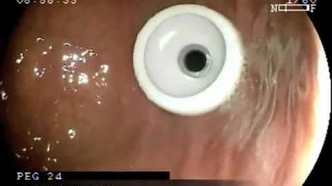 Como é uma cirurgia de GTT?