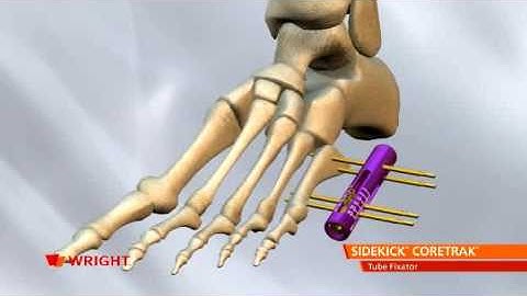 Wright - Sidekick Coretrak Tube