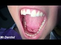 Dental Composite Restoration Of Frontal Tooth !!!