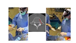 Download Lagu CNS-neurochirurgie 100: Technieken voor open thoracolumbale instrumentatie MP3