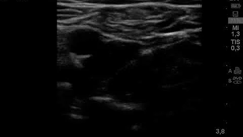 cayado femoral profunda
