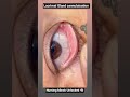 Lacrimal Gland cannulaisation #medical #medicine #medicalstudent #medicaleducation #nursing #gnm